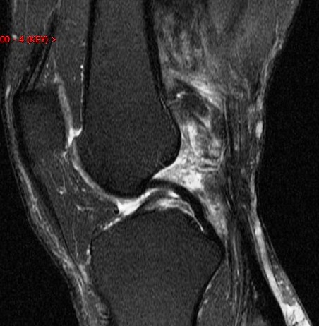 Figure 2 for case aggressive fibromatosis ( RID4292 )